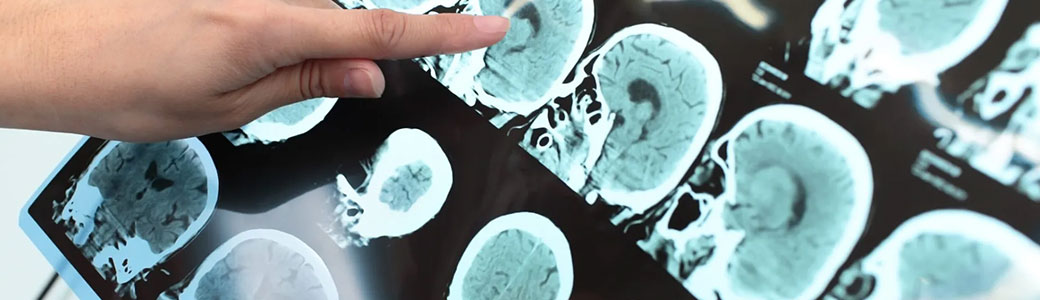 Alzheimer : un nouveau médicament approuvé aux États-Unis